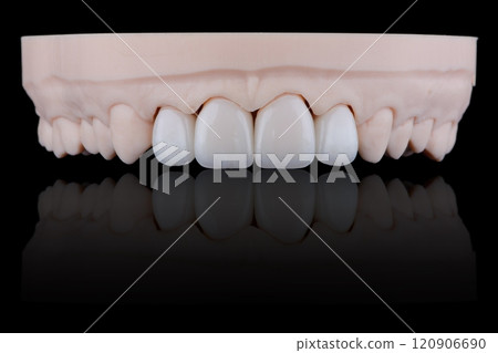 Four dental ultra-thin ceramic veneers in bleach color for fixation to frontal teeth of upper jaw. 120906690