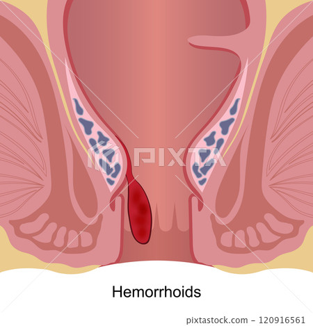 Hemorrhoids are swollen veins in the lower rectum and anus. 120916561