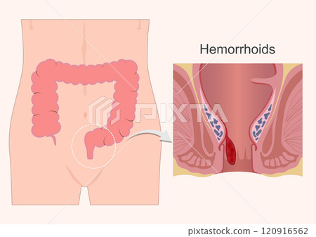 Hemorrhoids or piles are anal cushions. 120916562