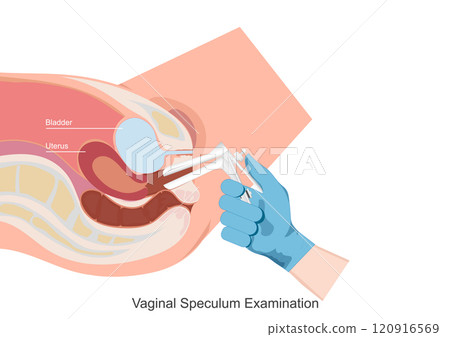 Vaginal Speculum Examination. 120916569