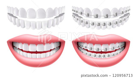 Teeth with or without braces. Arch braces without teeth. Orthodontic dentistry. The alignment of the teeth. Smile with white teeth and braces. Isolated realistic 3d vector Teeth with or without braces. Arch braces without teeth. Orthodontic dentistry. The alignment of the teeth. Smile with white teeth and braces. Isolated realistic 3d vector 120956713