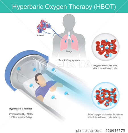 Hyperbaric Oxygen Therapy. A man has recumbent in tunnel glass for hyperbaric oxygen therapy pass by respiratory into blood vessel. 120958575