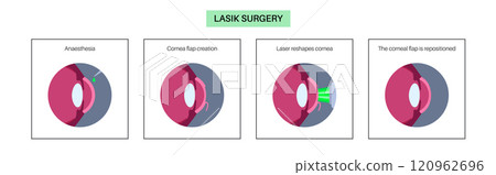 LASIK eye surgery 120962696