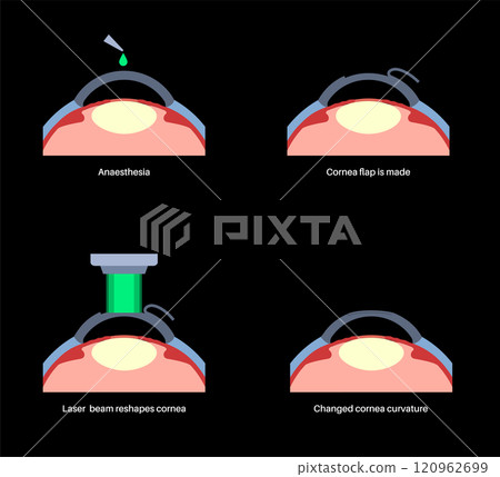 LASIK eye surgery 120962699
