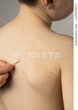 Treatment of chickenpox, application of an antipruritic and anti-inflammatory agent to the vesicles. 120989977