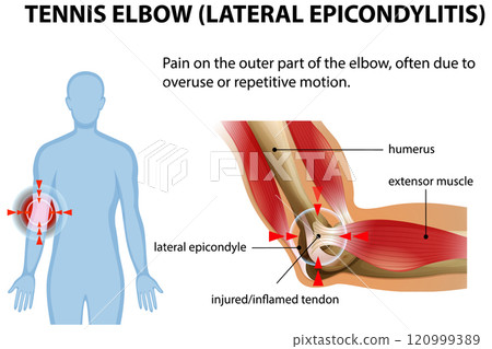Understanding Tennis Elbow and Its Causes 120999389