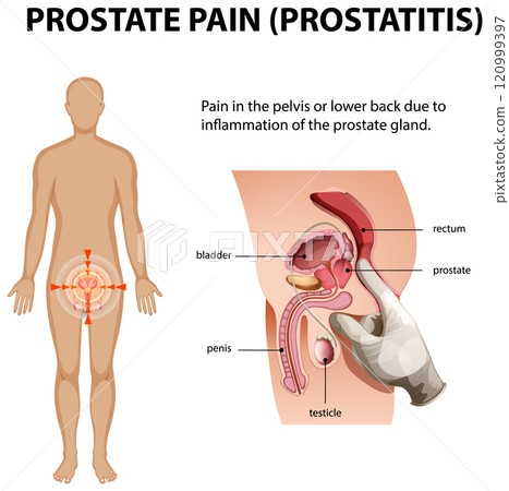 Understanding Prostate Pain and Inflammation 120999397