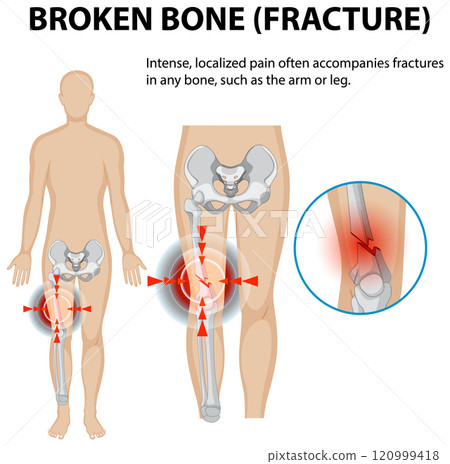 Understanding Bone Fractures and Pain 120999418