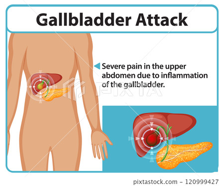 Understanding Gallbladder Attack Symptoms Understanding Gallbladder Attack Symptoms 120999427