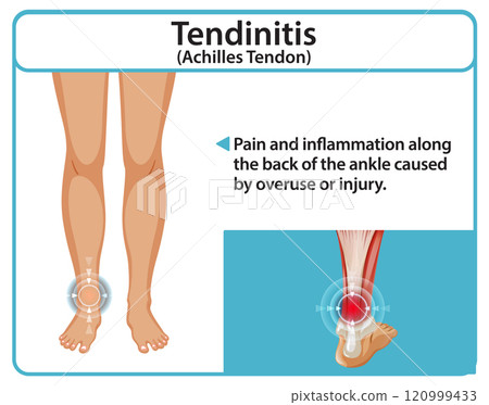 Achilles Tendonitis Medical Illustration 120999433