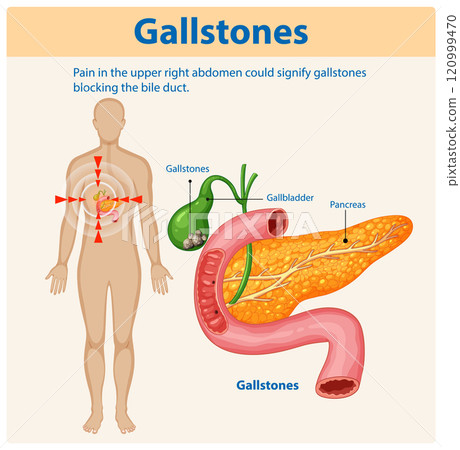 Understanding Gallstones and Their Effects 120999470