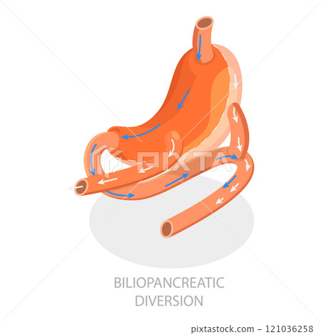 3D Isometric Flat  Illustration of Types Of Bariatric Surgery. Item 1 121036258