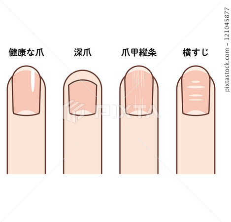 Illustrations of fingertips (healthy nails, deep nails, nail stripes, corrugated nails) 121045877