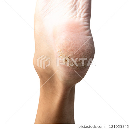 Man dry skin, cracked heels on the feet Isolated on white background 121055845