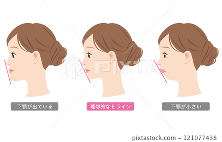 Mandibular prognathism, E-line, profile, jaw Mandibular prognathism, E-line, profile, jaw 121077438