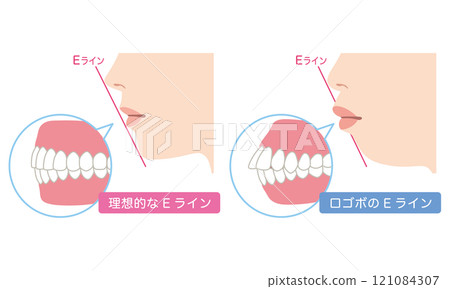 Ideal E-line and protruding E-line profile 121084307