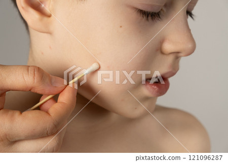 Treatment of chickenpox, application of an antipruritic and anti-inflammatory agent to the vesicles. Treatment of chickenpox, application of an antipruritic and anti-inflammatory agent to the vesicles. 121096287