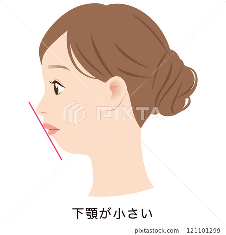 Small lower jaw, adenoid face, E-line, profile 121101299