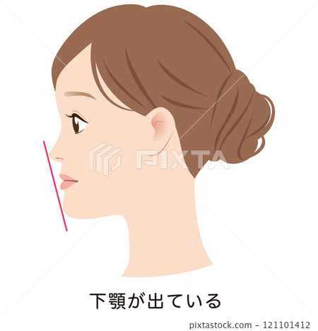 下顎前突的輪廓,下牙突出的 E 線 下顎前突的輪廓,下牙突出的 E 線 121101412