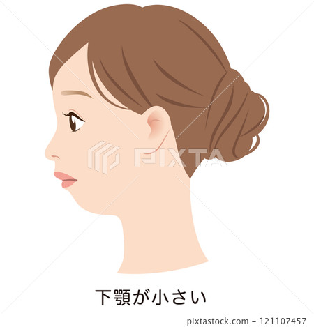 小下顎嘴、腺樣體臉、E 線、輪廓 121107457