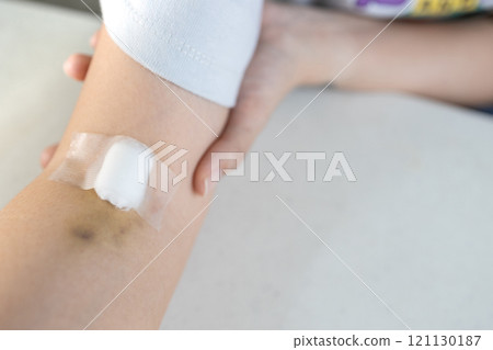 Close up,Arm of woman with bruise on foldable joint after taking blood sample,plaster and cotton to cover wound,painful in arm,concept of blood test,medical examination,health checkup,blood donation 121130187