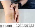 Arm of woman with bruise on foldable joint from needle,injection,fragile vein,broken capillary blood vessel under skin,physical pain and injury,problem after blood test,medical checkup,blood donation 121130188
