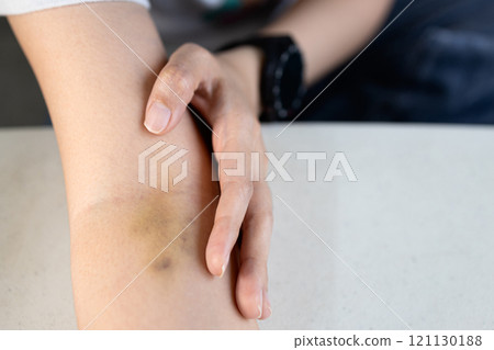 Arm of woman with bruise on foldable joint from needle,injection,fragile vein,broken capillary blood vessel under skin,physical pain and injury,problem after blood test,medical checkup,blood donation 121130188