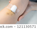 Arm of woman with bruise on foldable joint after taking blood sample,pain in her arm,fragility of vein or capillary,problems of blood test,blood donation,medical examination,health checkup concept 121130571