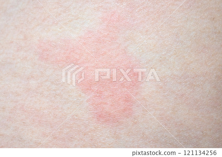 Skin allergy rash dermatitis texture close up 121134256