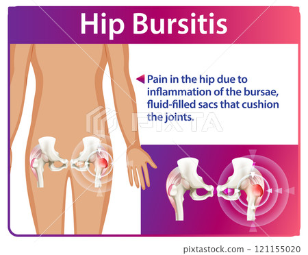 Understanding Hip Bursitis and Its Effects Understanding Hip Bursitis and Its Effects 121155020