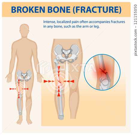 Understanding Bone Fractures and Pain Understanding Bone Fractures and Pain 121155050
