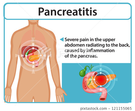 Understanding Pancreatitis and Its Symptoms 121155065