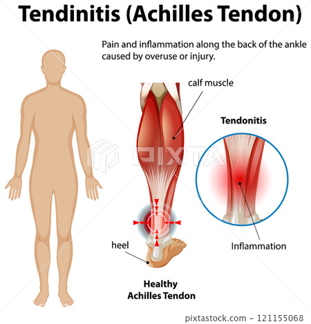 Achilles Tendonitis Medical Illustration 121155068