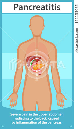 Understanding Pancreatitis and Its Symptoms 121155085