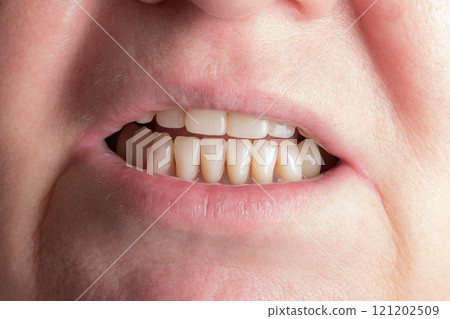 Prosthetics and orthodontic treatment. A woman demonstrates removable dentures. 121202509