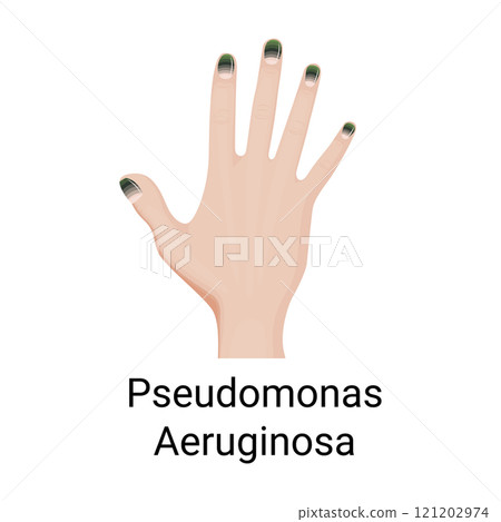 Green Nail Syndrome, fingernail chloronychia symptom 121202974