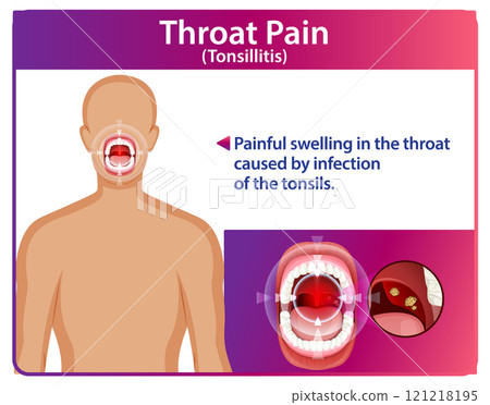 Understanding Throat Pain and Tonsillitis 121218195