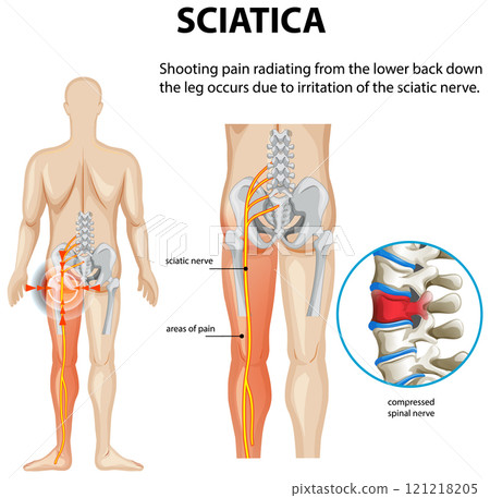 Understanding Sciatica and Nerve Pain 121218205