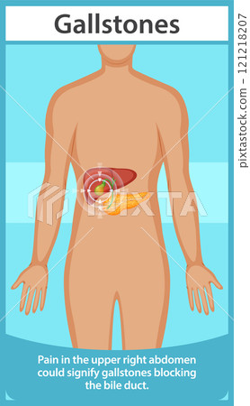 Understanding Gallstones and Their Symptoms 121218207