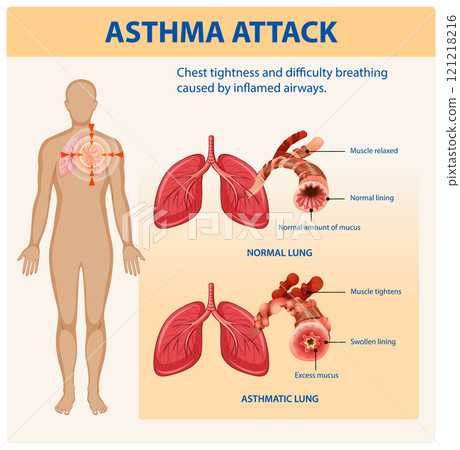 Understanding Asthma and Lung Function Understanding Asthma and Lung Function 121218216