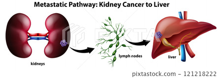 Metastatic Pathway: Kidney to Liver 121218222