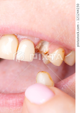Bad damage tooth, lost teeth Bad damage tooth, lost teeth 121244150