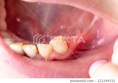 Bad damage tooth, lost teeth 121244152