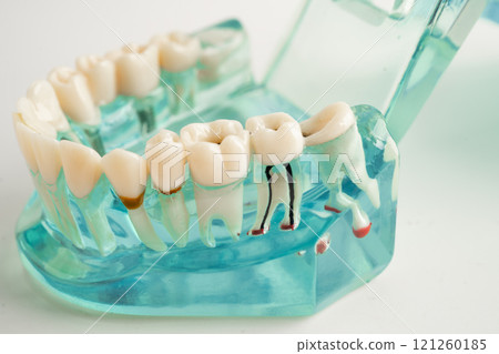 Dental implant, artificial tooth roots into jaw, root canal of dental treatment, gum disease, teeth model for dentist studying about dentistry. 121260185