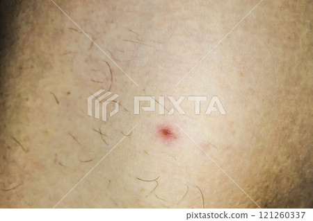 Problem skin with acne and dark unwanted hairs. Problem skin with acne and dark unwanted hairs. 121260337