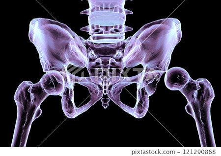 Hip dysplasia, 3D illustration 121290868