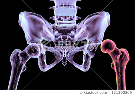 Hip dysplasia, 3D illustration 121290869