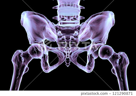 Hip dysplasia, 3D illustration 121290871