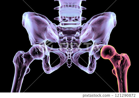 Hip dysplasia, 3D illustration Hip dysplasia, 3D illustration 121290872
