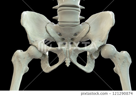 Hip dysplasia, 3D illustration Hip dysplasia, 3D illustration 121290874
